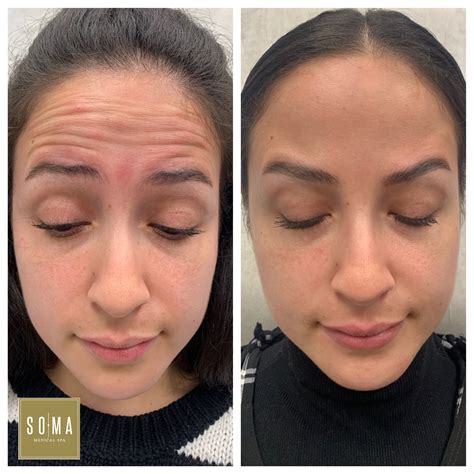 Botox Images に対する画像結果