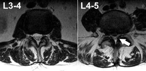 Abnormal MRI Lumbar Spine に対する画像結果