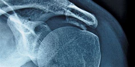 Image result for Shoulder Pain Internal Rotation