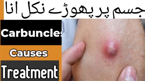 Image result for Carbuncle Definition