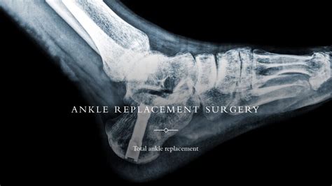 What Is an Ankle Replacement に対する画像結果