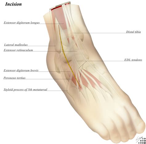 Ankle Posterolateral Approach に対する画像結果