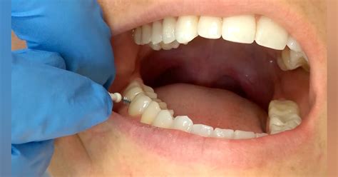 Image result for Overhang Tissue