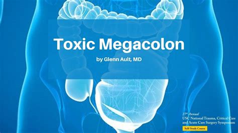 Toxic Megacolon Next to Normal に対する画像結果