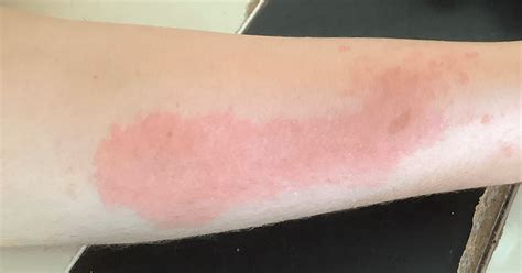 Rhus Dermatitis Face-এর ছবি ফলাফল