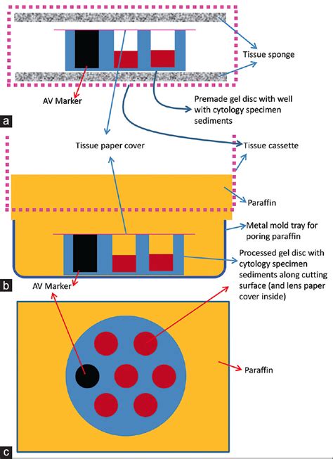 Cell Block Preparation From Different Body Fluids に対する画像結果
