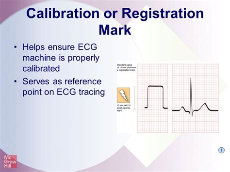 The Electrocardiogram - ppt video online download