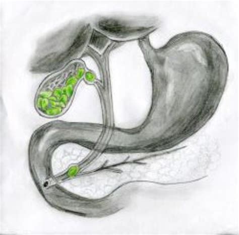 Image result for Gallbladder Has Sludge