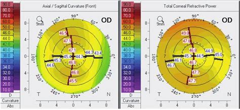 ClearVision Multifocal IOL に対する画像結果