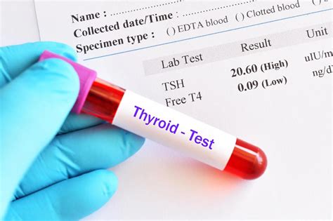 Image result for Thyroid Lab Test Form