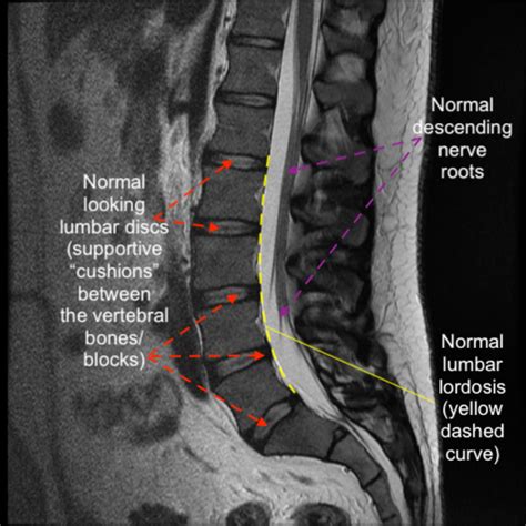 Abnormal MRI Lumbar Spine に対する画像結果