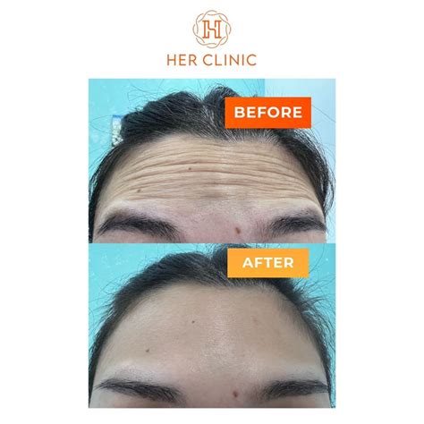 Image result for Botox Bodiline