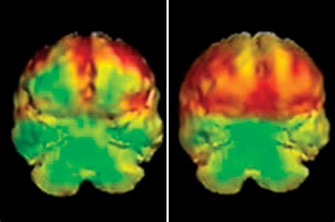 Image result for Prefrontal Cortex Brain Scan