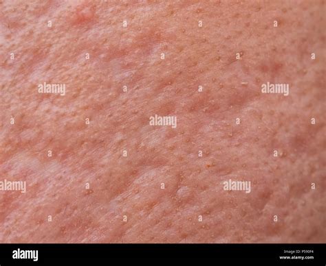 Inside Nodule Acne に対する画像結果