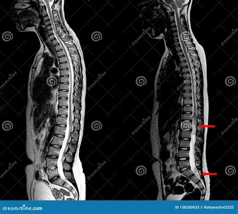 Abnormal MRI Lumbar Spine に対する画像結果