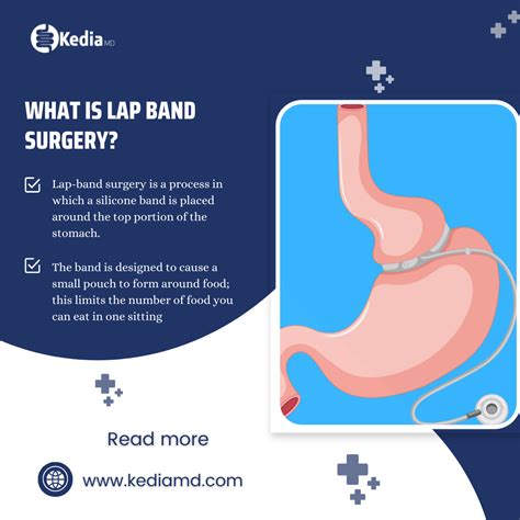 Lap Band Doctors 的图像结果