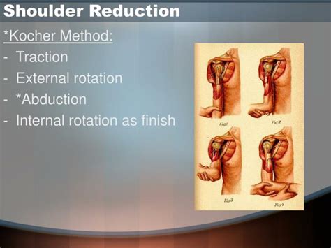 Image result for Anterior Shoulder Reduction Technique