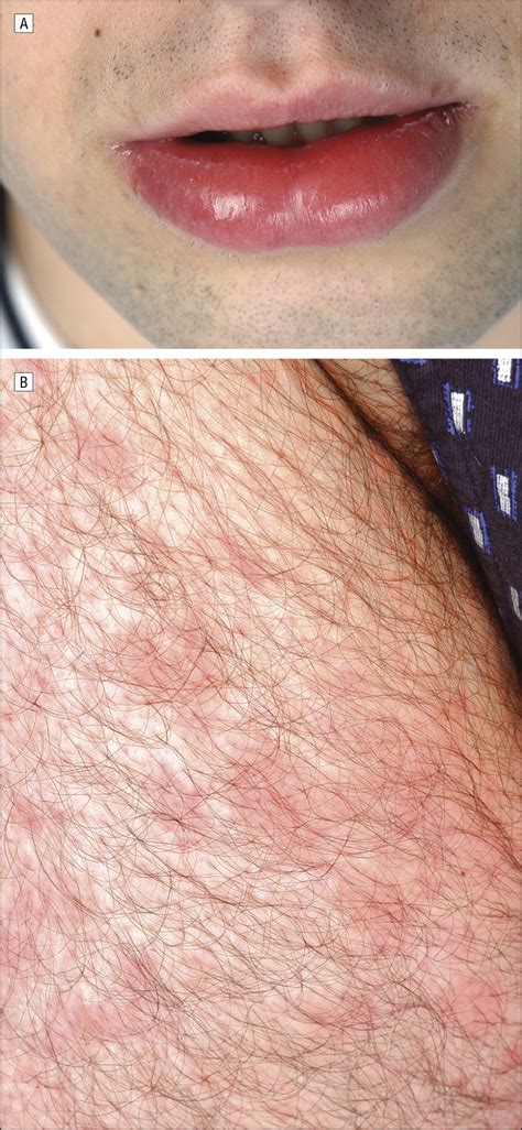 Image result for Delayed Allergic Reaction