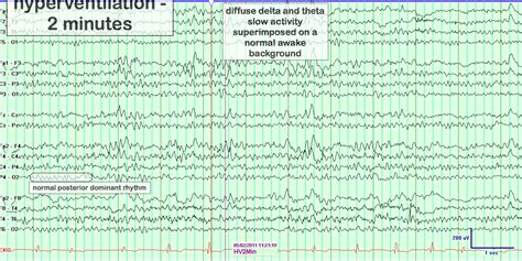 Hyperventilation Antimation に対する画像結果
