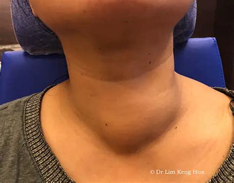 Thyroid Swelling Algorithm ಗಾಗಿ ಇಮೇಜ್ ಫಲಿತಾಂಶ