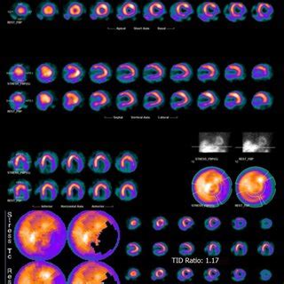 Image result for Siemens Orbiter Nuclear Stress Test