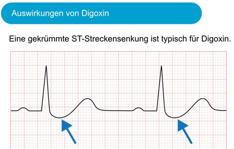 Toradh íomhá ar Digoxin ST Depression