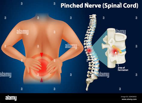 Image result for Pin Nerve