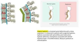 Afbeeldingsresultaten voor Angular Kyphosis TB Spine