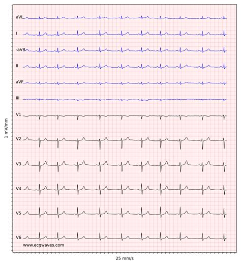 Image result for Normal Heart Rate On an ECG