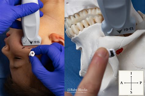 Image result for Maxillary Nerve Block