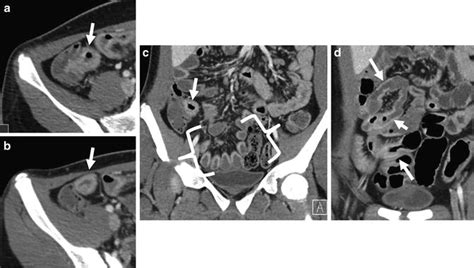 Image result for CT Enterography