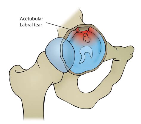 Right Hip Labrum に対する画像結果