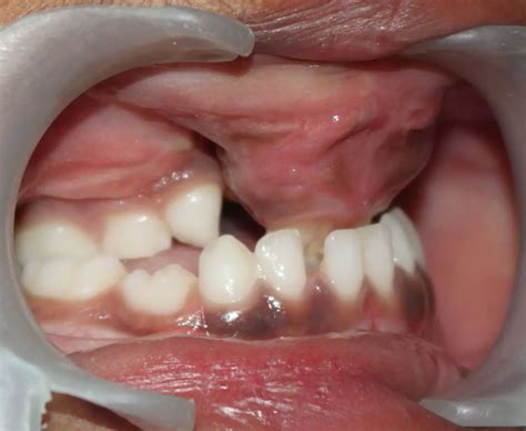 Image result for Maxillary Protraction