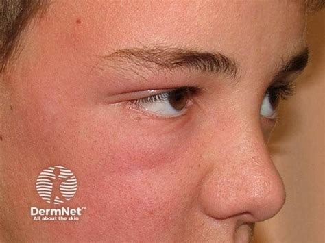 Rhus Dermatitis Face-এর ছবি ফলাফল