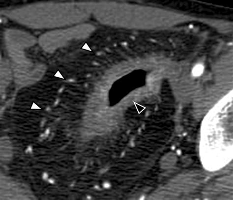 Image result for CT Enterography