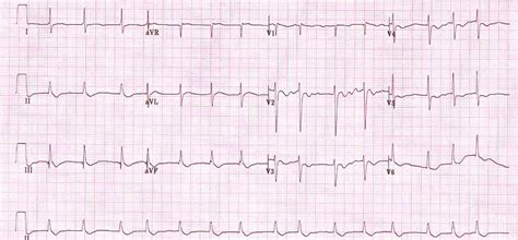 Toradh íomhá ar Digoxin ST Depression