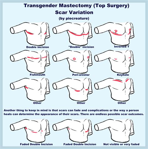 Top Surgery Types に対する画像結果
