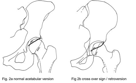 Toradh íomhá ar Femoral Anteversion vs Retroversion