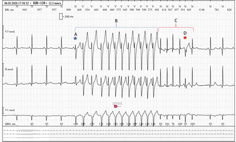 Toradh íomhá ar Broad Complex Tachy Als Algorithm