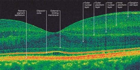 Image result for Oct Eye Scan Glaucoma