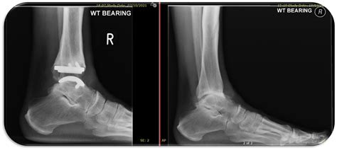What Is an Ankle Replacement に対する画像結果