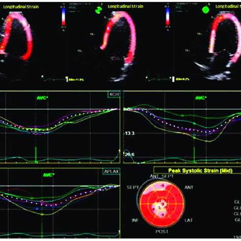 Toradh íomhá ar Speckle Tracking Algorithm