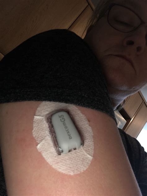 Afbeeldingsresultaten voor Dexcom Sensor Placement