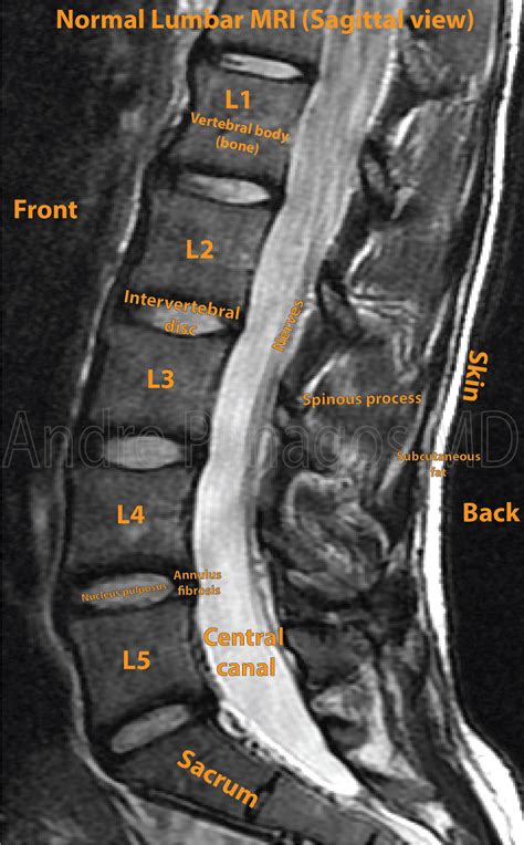 Abnormal MRI Lumbar Spine に対する画像結果