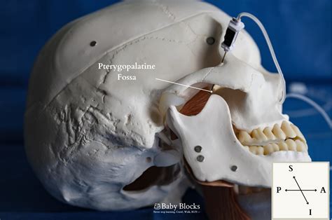 Image result for Maxillary Nerve Block