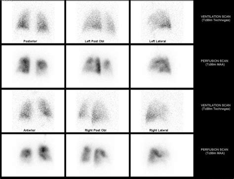 Image result for Abnormal VQ