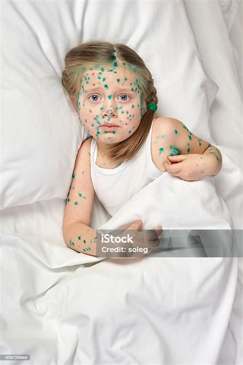 Image result for Skin Virus