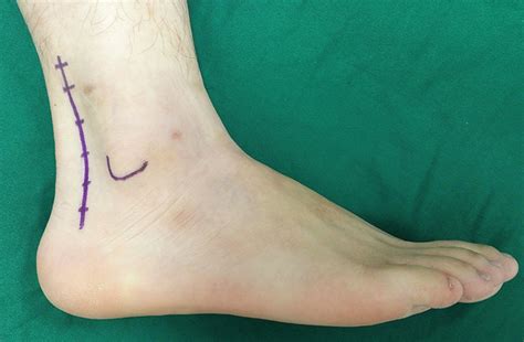Ankle Posterolateral Approach に対する画像結果