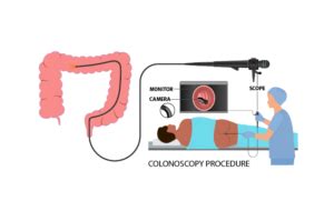 Image result for Colonoscopy Mins