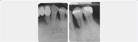 Angular Bone Defect Classification に対する画像結果